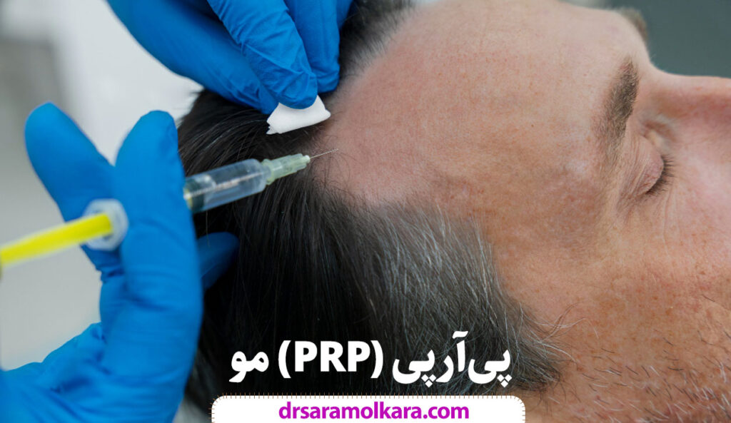 درمان ریزش مو با PRP در مشهد