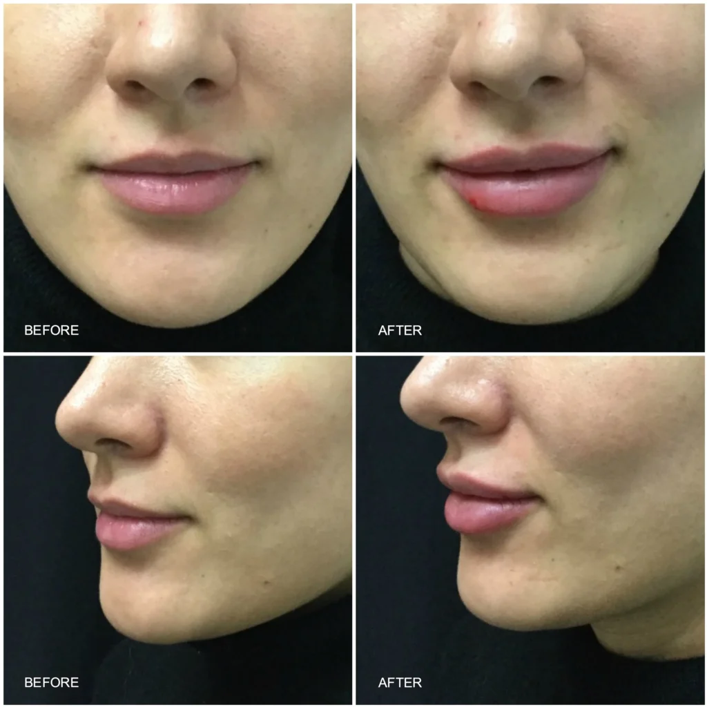 تاثیر بوتاکس لب و چانه