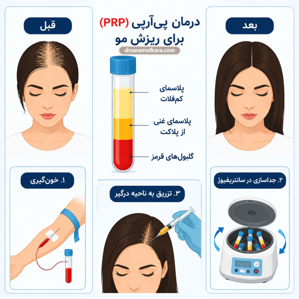پی‌آر‌پی (PRP) چیست