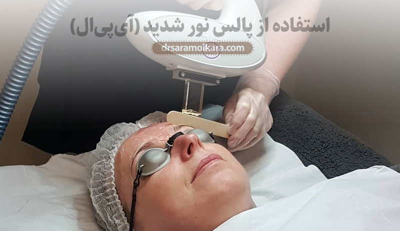 استفاده از پالس نور شدید (آی‌پی‌ال)