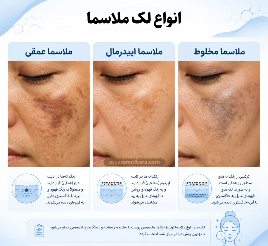 انواع لک ملاسما