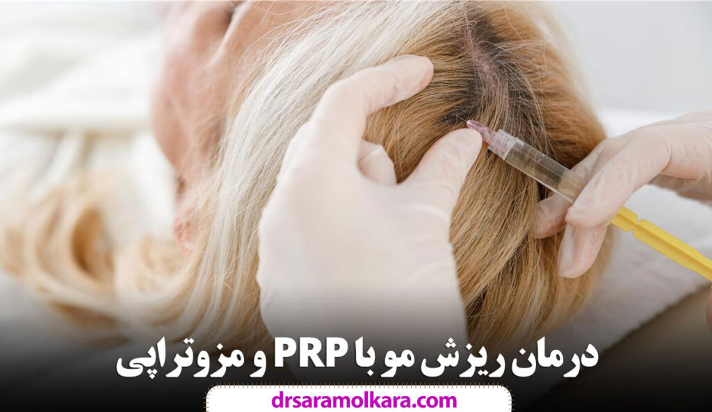 درمان ریزش مو با PRP و مزوتراپی در مشهد