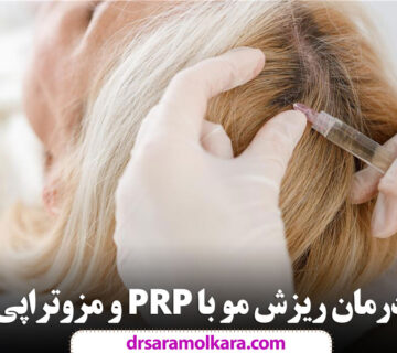 درمان ریزش مو با PRP و مزوتراپی در مشهد