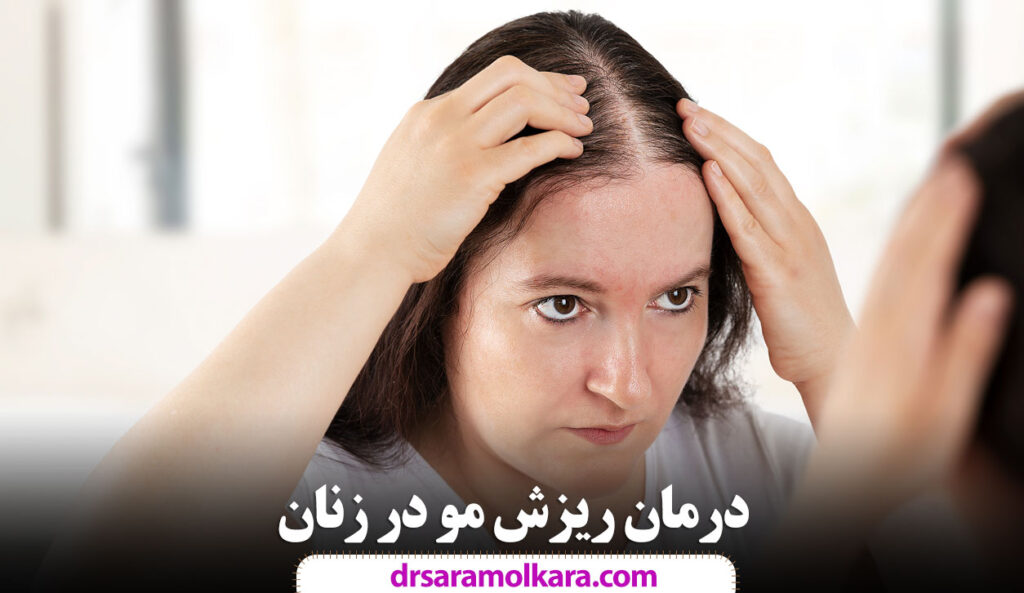 درمان ریزش مو در زنان