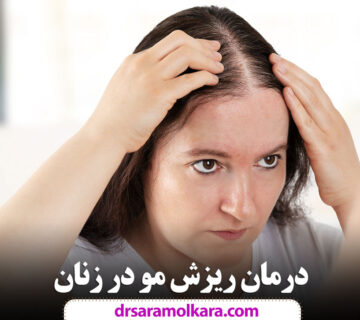 درمان ریزش مو در زنان