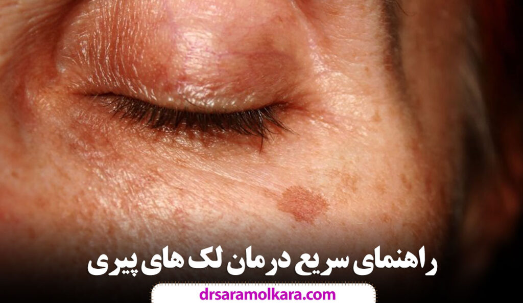 راهنمای سریع درمان لک های پیری