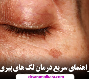 راهنمای سریع درمان لک های پیری