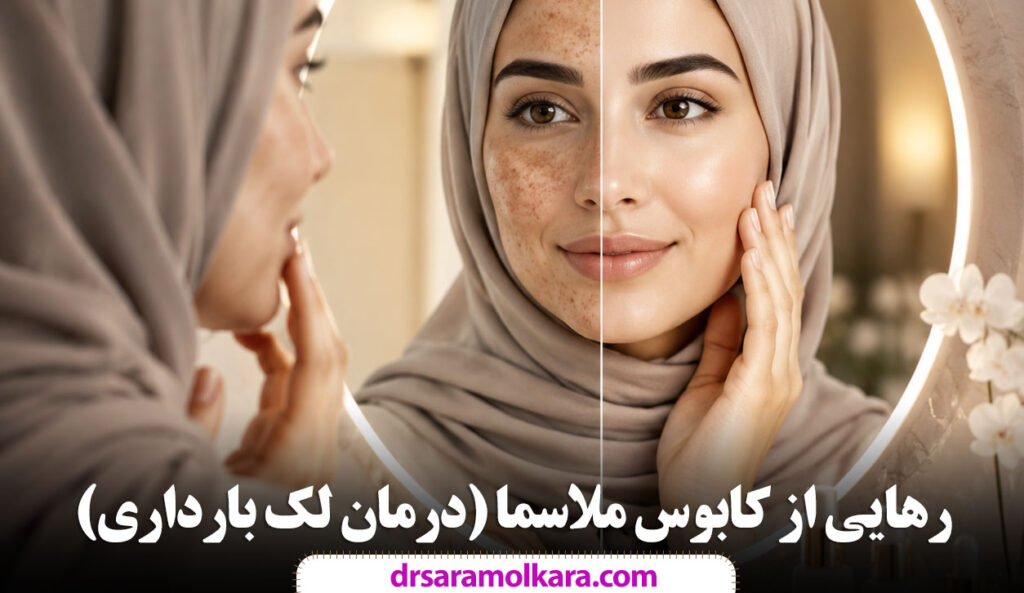رهایی از کابوس ملاسما درمان لک بارداری