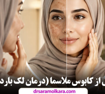 رهایی از کابوس ملاسما درمان لک بارداری
