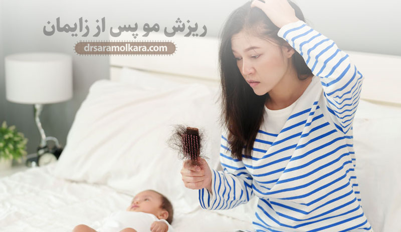 ریزش مو پس از زایمان