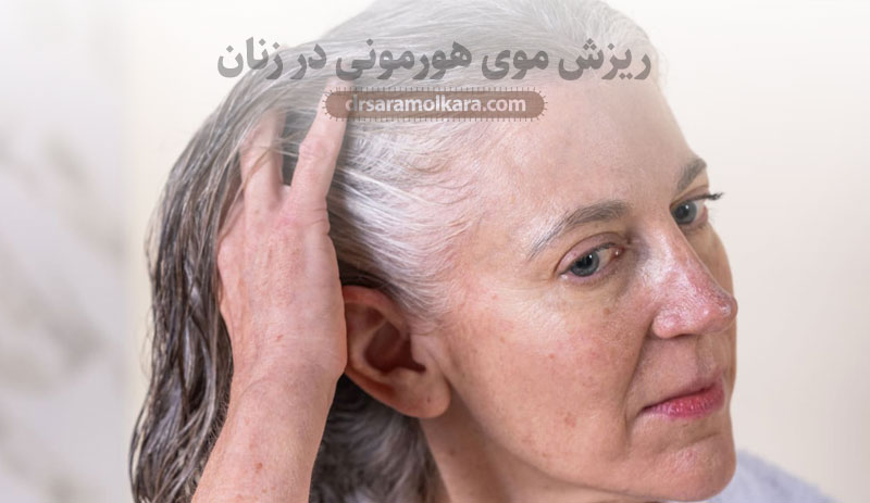 ریزش موی هورمونی در زنان