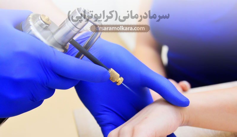سرمادرمانی (کرایوتراپی) 