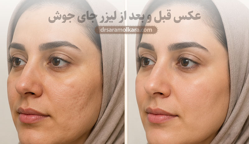 عکس قبل و بعد از لیزر جای جوش