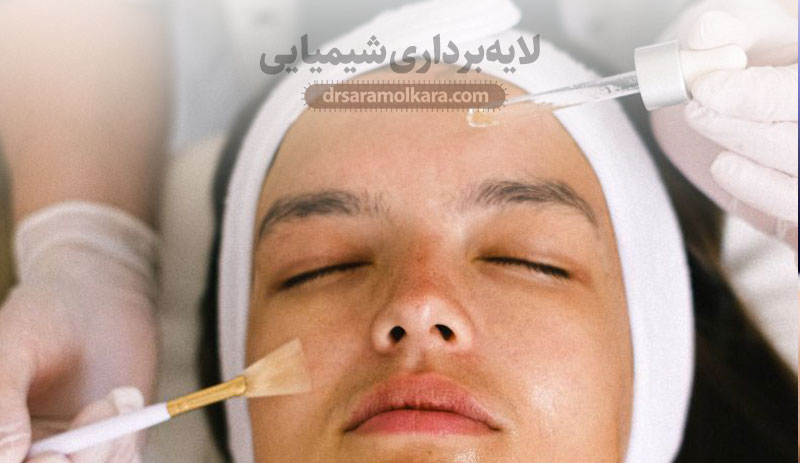 لایه‌برداری شیمیایی