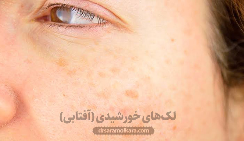 لک‌های خورشیدی (آفتابی)