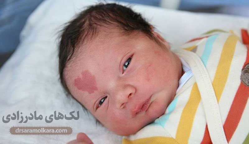 لک‌های مادرزادی