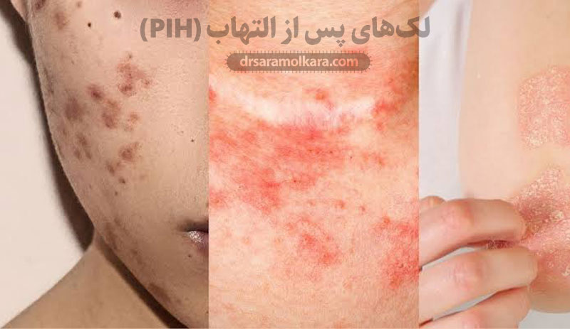 لک‌های پس از التهاب (PIH)