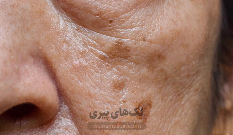 لک‌های پیری