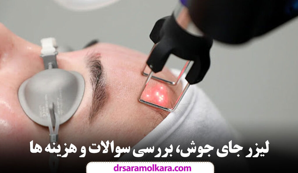 لیزر جای جوش، بررسی سوالات و هزینه ها