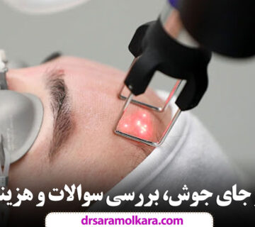 لیزر جای جوش، بررسی سوالات و هزینه ها