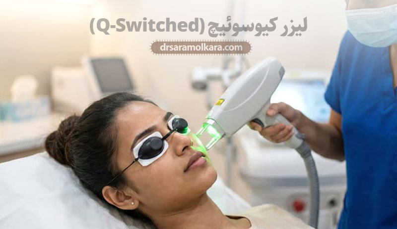 لیزر کیوسوئیچ (Q-Switched) 