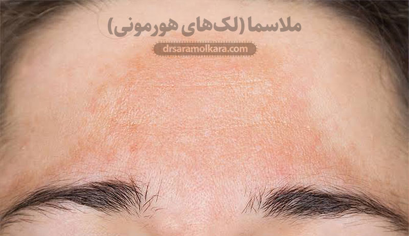 ملاسما (لک‌های هورمونی)