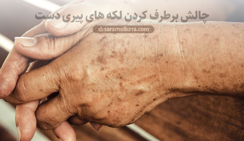 چالش برطرف کردن لکه های پیری دست