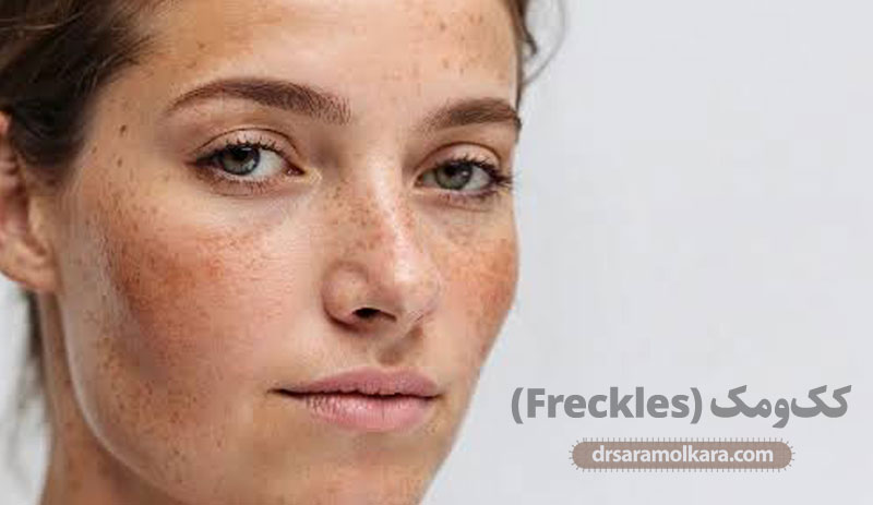 کک‌ومک (Freckles)