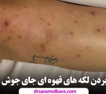 از بین بردن لکه های قهوه ای جای جوش روی پا