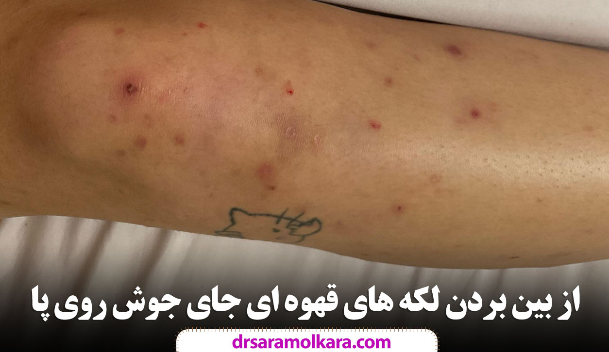 از بین بردن لکه های قهوه ای جای جوش روی پا