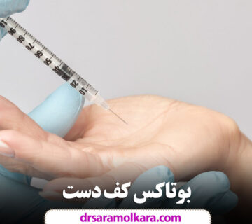 بوتاکس کف دست در مشهد