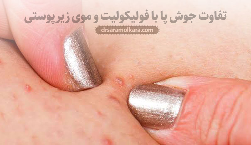 تفاوت جوش پا با فولیکولیت و موی زیرپوستی