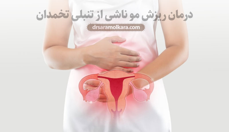 درمان ریزش مو ناشی از تنبلی تخمدان