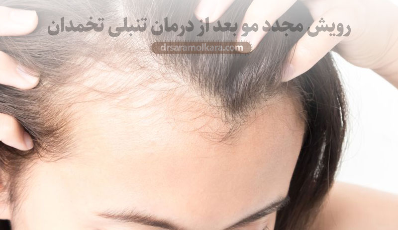 رویش مجدد مو بعد از درمان تنبلی تخمدان