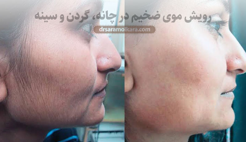 رویش موی ضخیم در چانه، گردن و سینه