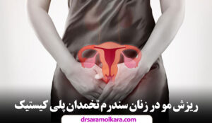 ریزش مو در زنان سندرم تخمدان پلی کیستیک