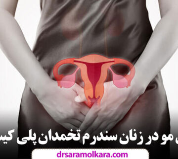 ریزش مو در زنان سندرم تخمدان پلی کیستیک