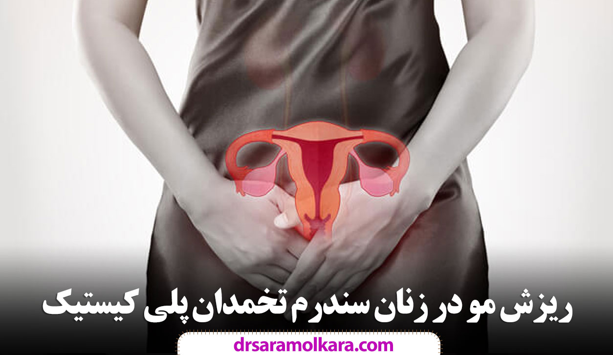 ریزش مو در زنان سندرم تخمدان پلی کیستیک