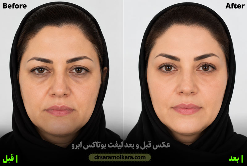 قبل و بعد بوتاکس ابرو