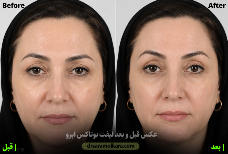 بوتاکس برای لیفت ابرو