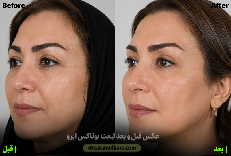 بوتاکس زیر ابرو
