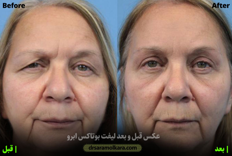 تزریق بوتاکس ابرو