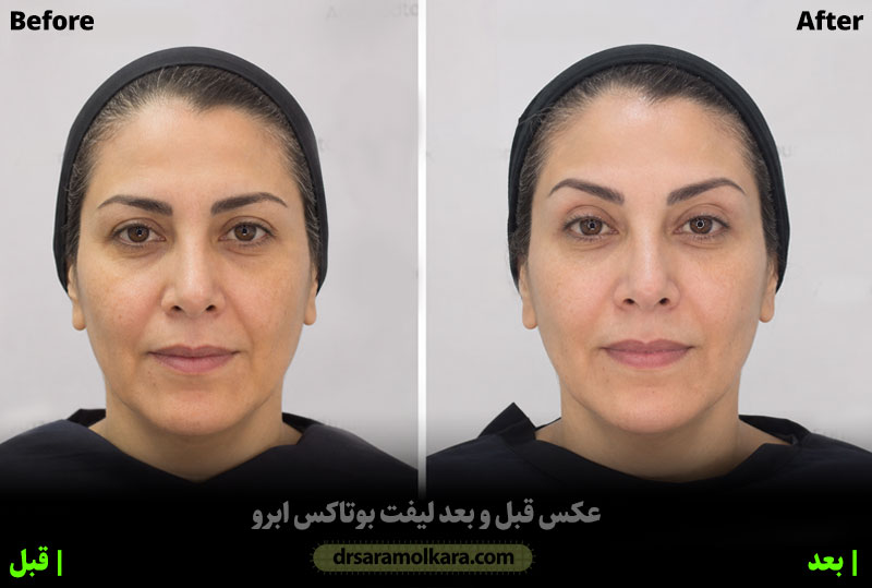 بوتاکس ابرو قبل و بعد