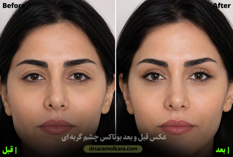 عکس قبل و بعد بوتاکس چشم گربه ای 