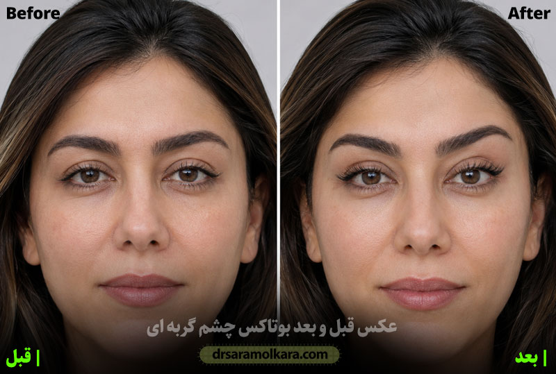 قبل و بعد بوتاکس چشم گربه ای 