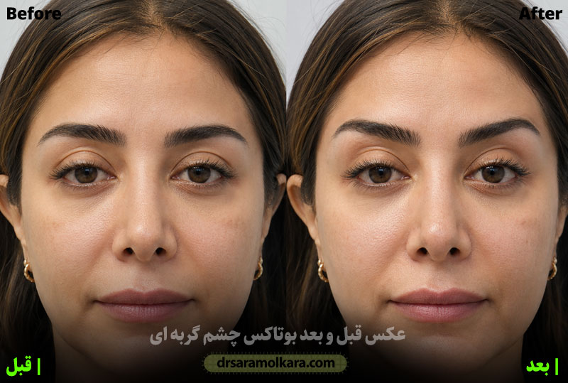  بوتاکس چشم گربه ای 