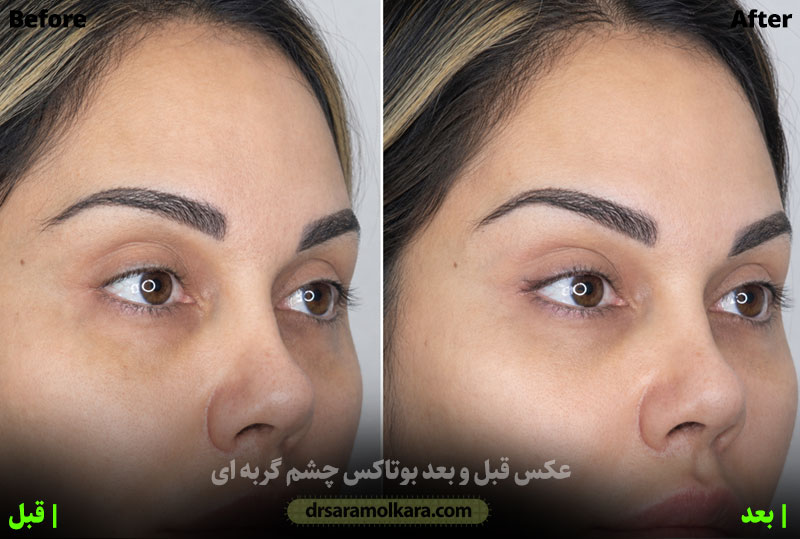 عکس قبل و بعد بوتاکس چشم گربه ای 