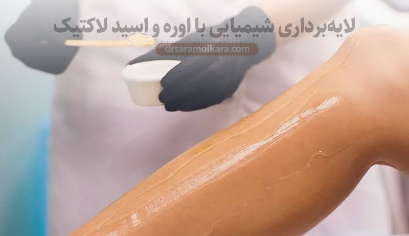 لایه‌برداری شیمیایی با اوره و اسید لاکتیک