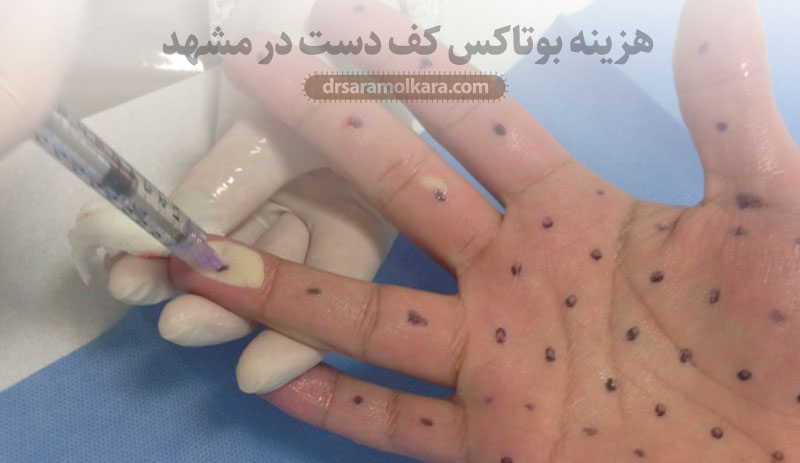 هزینه بوتاکس کف دست در مشهد