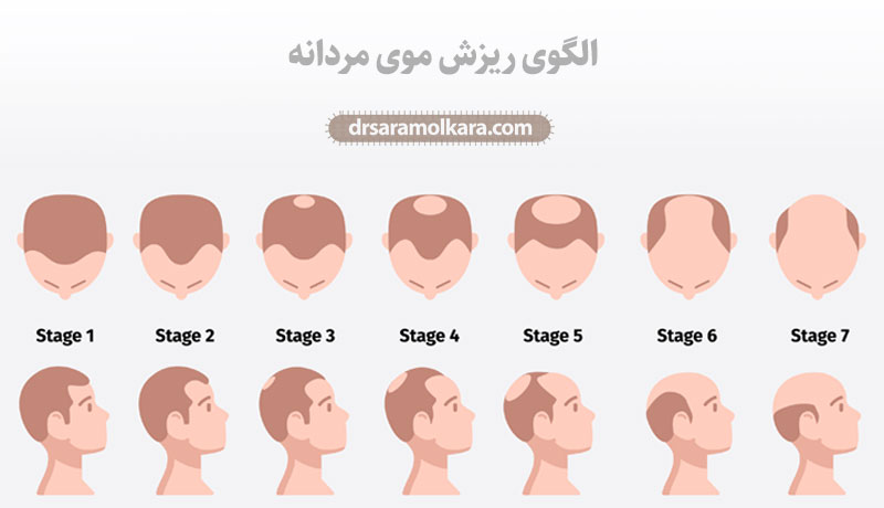 الگوی ریزش موی مردانه